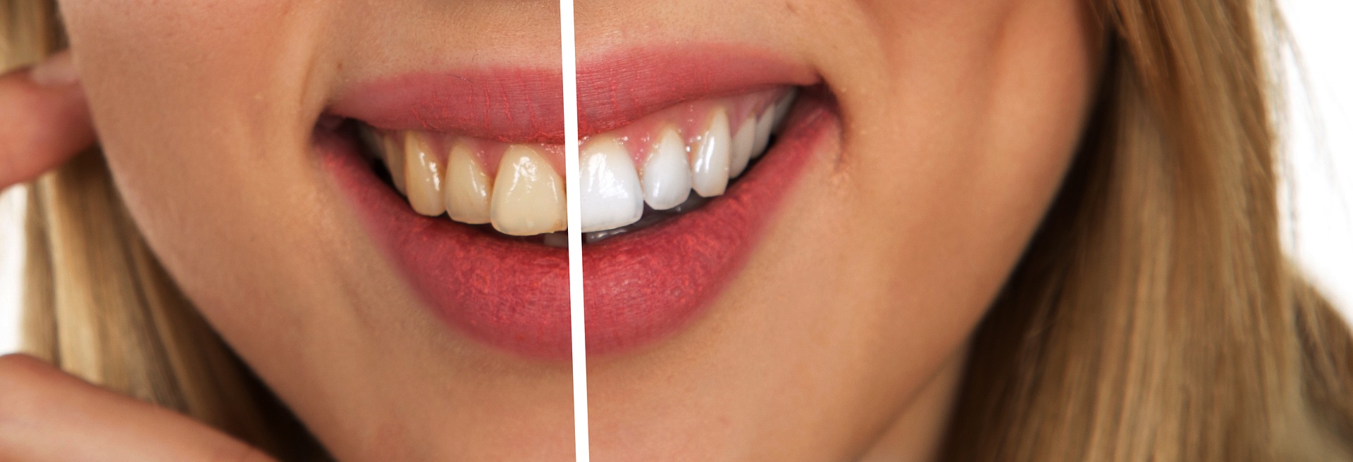 whitened teeth